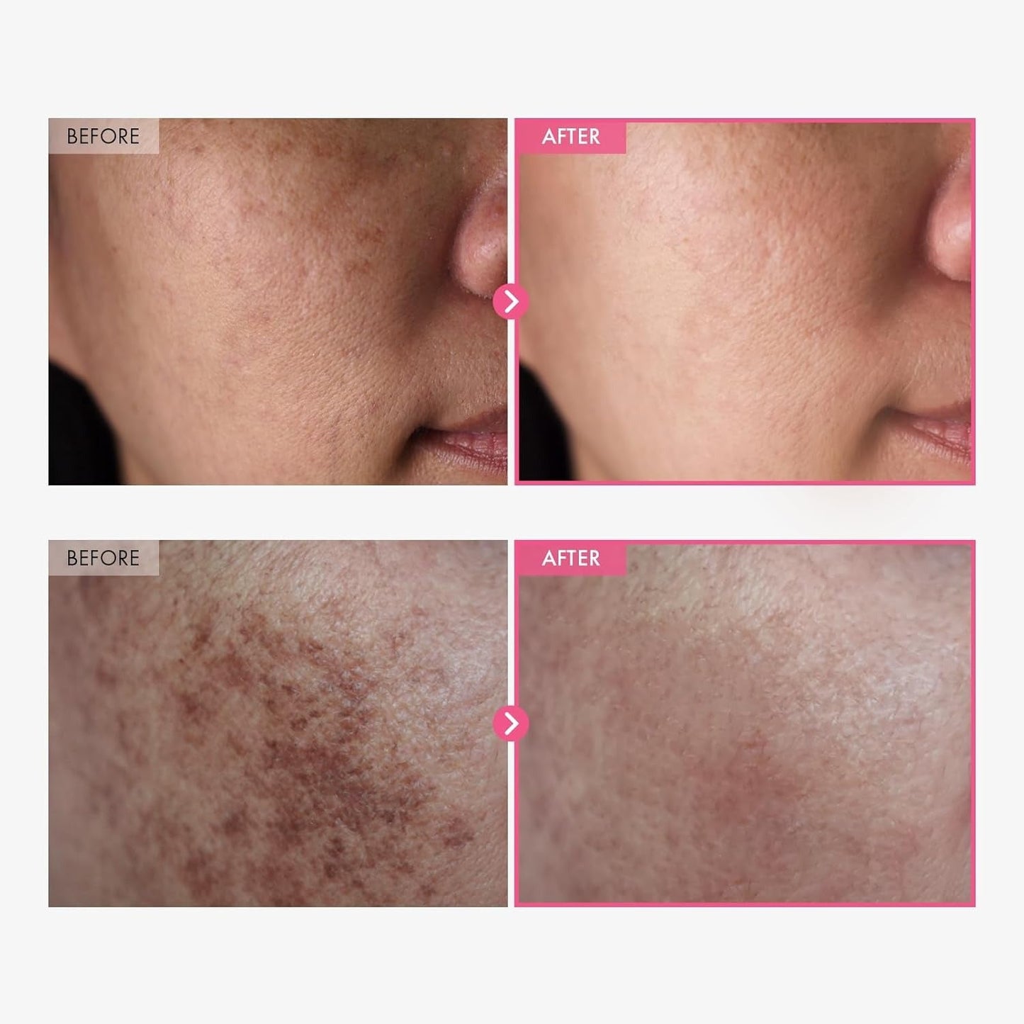 ✨ Arbutin 7% + Tranexamic Acid 4% Cream ✨